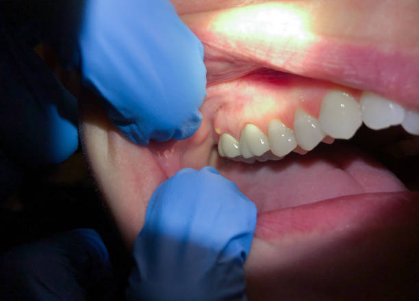Best Emergency Dentist for Lost Fillings or Crowns in Rutherford, NJ